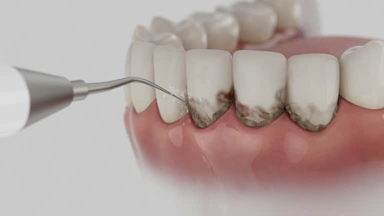 Reliable Invisalign Clear Aligners contractor in Knox, IN by Smile Center Dentistry